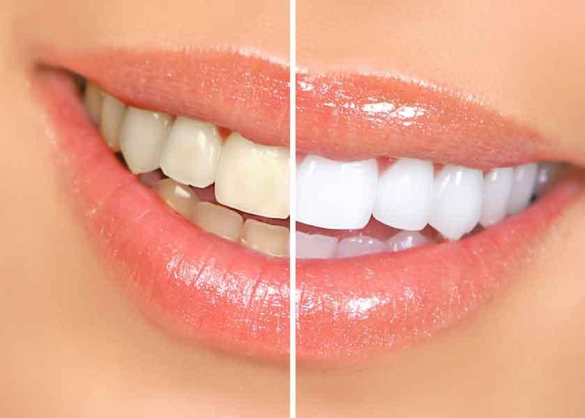 Before and after professional teeth whitening