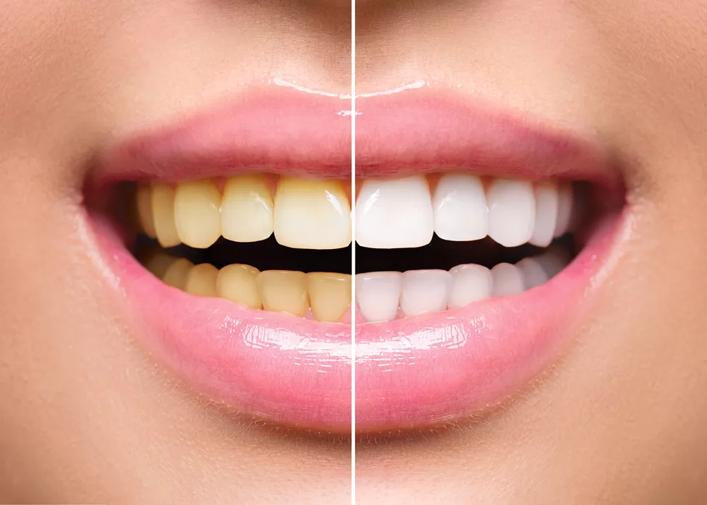 Teeth whitening in Perth